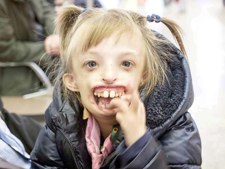 Girl, 6, born without half her face returns to Russia smiling and laughing for first time after surgery in UK