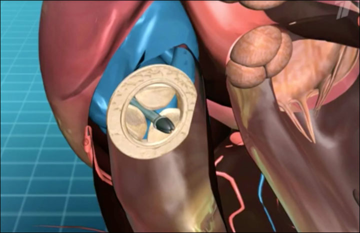 first in world replacement of child's heart valve without opening chest