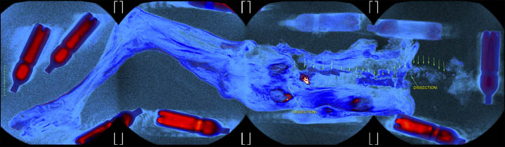 Ukok mummy MRI scan